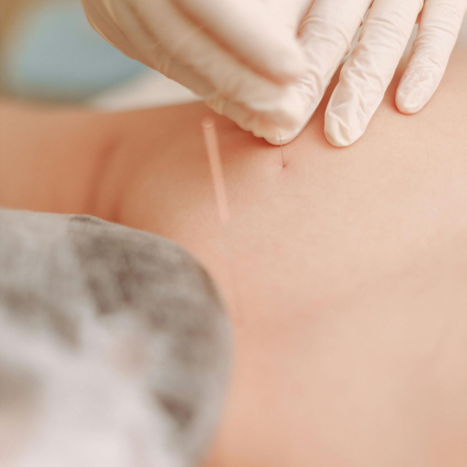 Therapist putting thin needle through skin over right shoulder blade